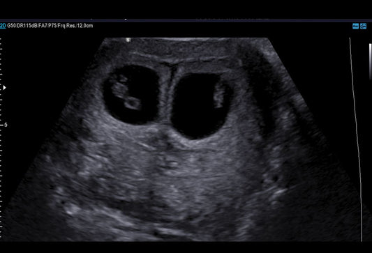 twin ultrasound